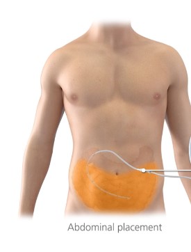 Abdominal placement
