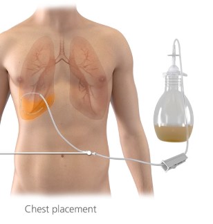 Chest placement
